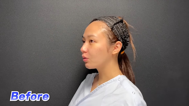 てんちむ、YouTubeで整形を報告の画像