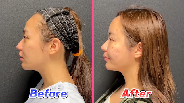 てんちむ、YouTubeで整形を報告の画像