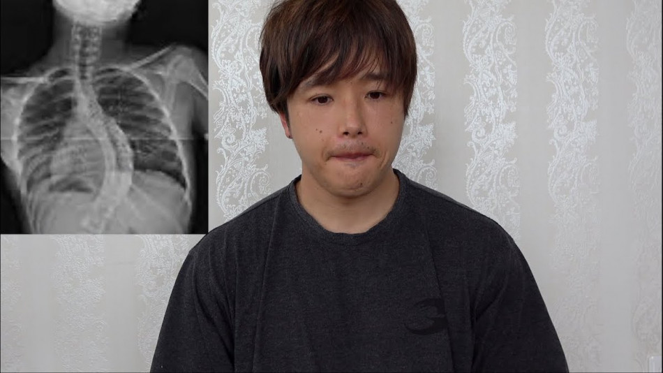 ぷろたん、側湾症を患ったことを報告