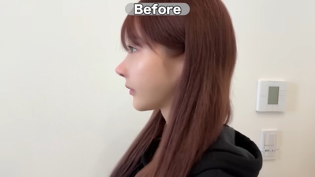 Rちゃん、総額30万円の整形手術を赤裸々公開の画像