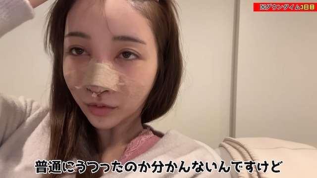 Rちゃん、4度目の鼻整形を報告の画像