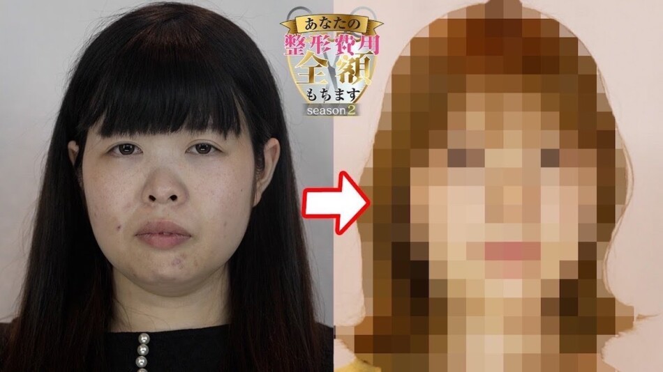 ヒカル、女性の1000万円超“全身整形”負担