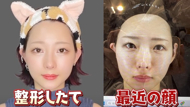 人気YouTuber、顔面骨折で再び整形の画像