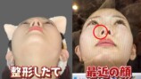 人気YouTuber、顔面骨折で再び整形の画像