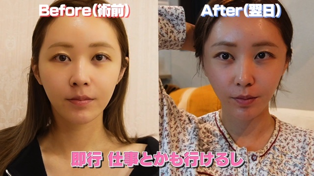 てんちむ、整形を告白の画像