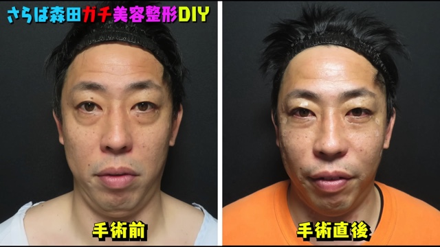 さらば森田、美容整形を告白の画像