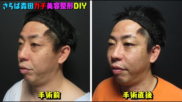 さらば森田、美容整形を告白の画像