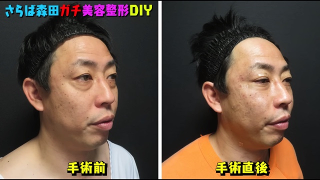 さらば森田、美容整形を告白の画像