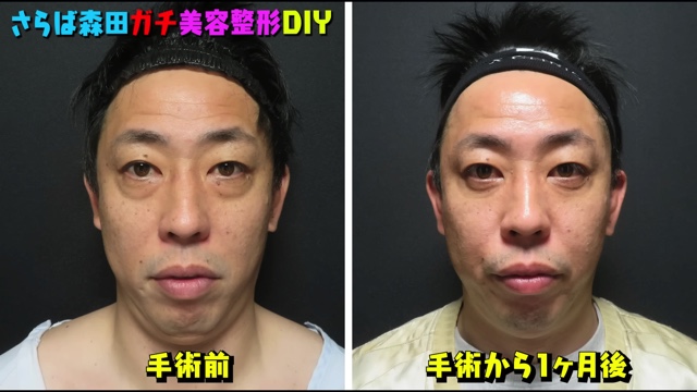 さらば森田、美容整形を告白の画像