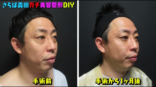 さらば森田、美容整形を告白の画像